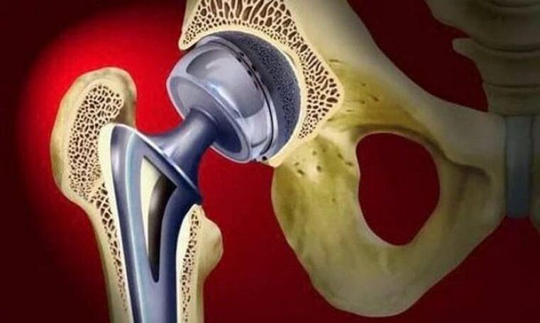 Endoprosthetiker