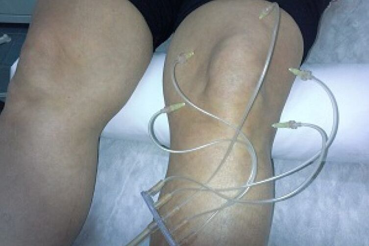 Ozonotherapie