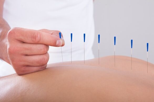 Akupuncture
