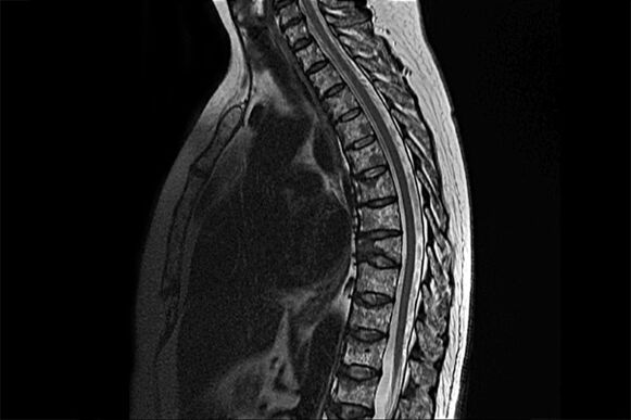 Manifestatiounen vun thoracic Osteochondrosis am Bild vu MRI