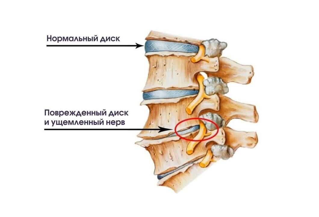 Symptomer vun der Gebärmutterhals Osteochendrosis