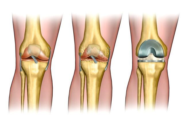 Grad vun Arthrosis