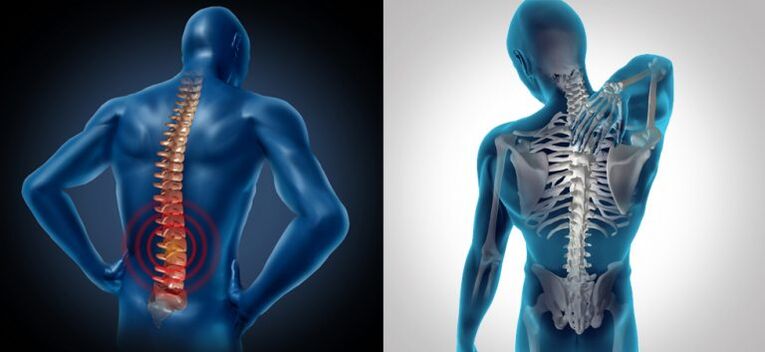 Entzündung am Spinal Osteochondros