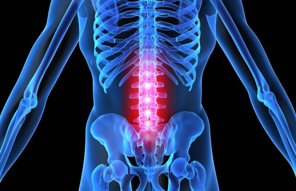 Osteochondrosis vun der Lendegpigelen