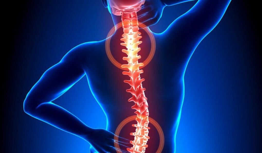 spinal Osteochondrose