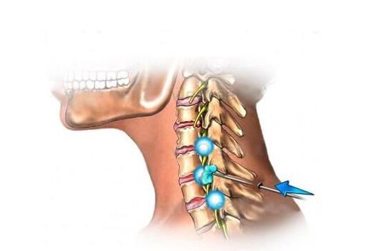 cervical osteochondrosis Behandlung